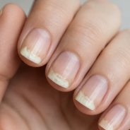 Onycholyse : causes, symptômes et traitement